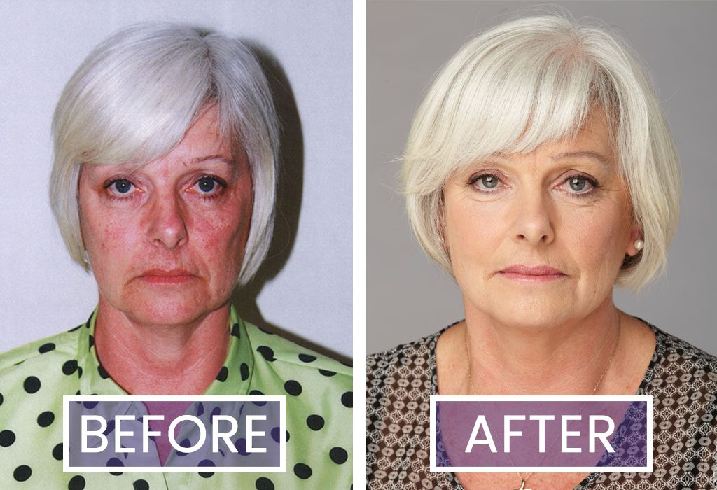 Before and After photographs of Facial Flex trialist Jackie Allen