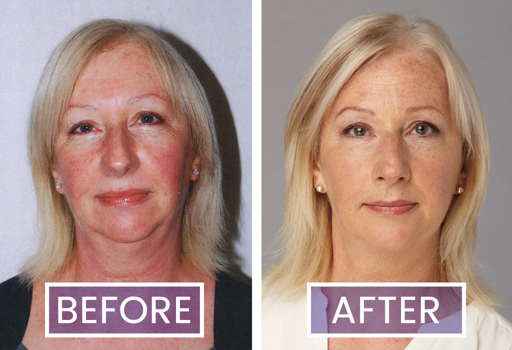Before and After photographs of Facial Flex trialist Lynne Pounder